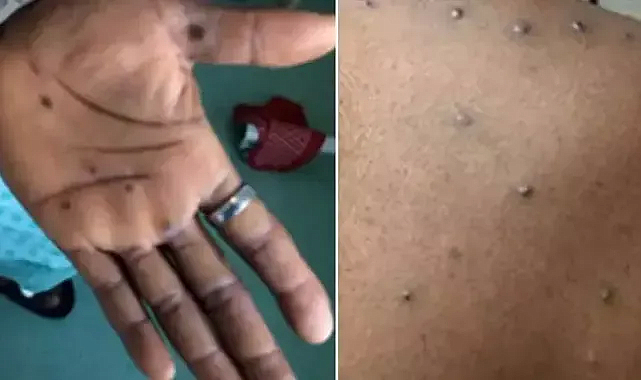 Maymun Çiçeği Virüsü Ne Kadar Tehlikeli ve Nasıl Korunmalıyız?