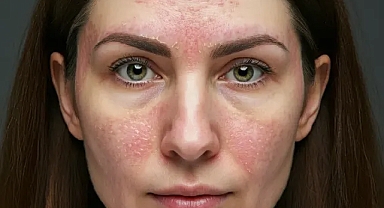 Dermatolog Dr. Süer'den Tavsiyeler: Kış Aylarında Artan Seboreik Dermatite Dikkat!
